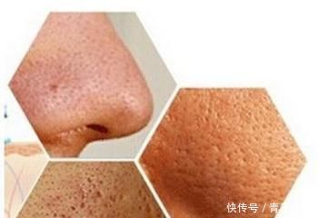 毛孔越来越大，是螨虫把你的脸当成寄宿地，3个方法教你摆脱困扰