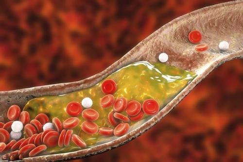 碳水化合物|高血脂的不能吃面条提醒若想血脂慢慢降，2种素食也不能多吃