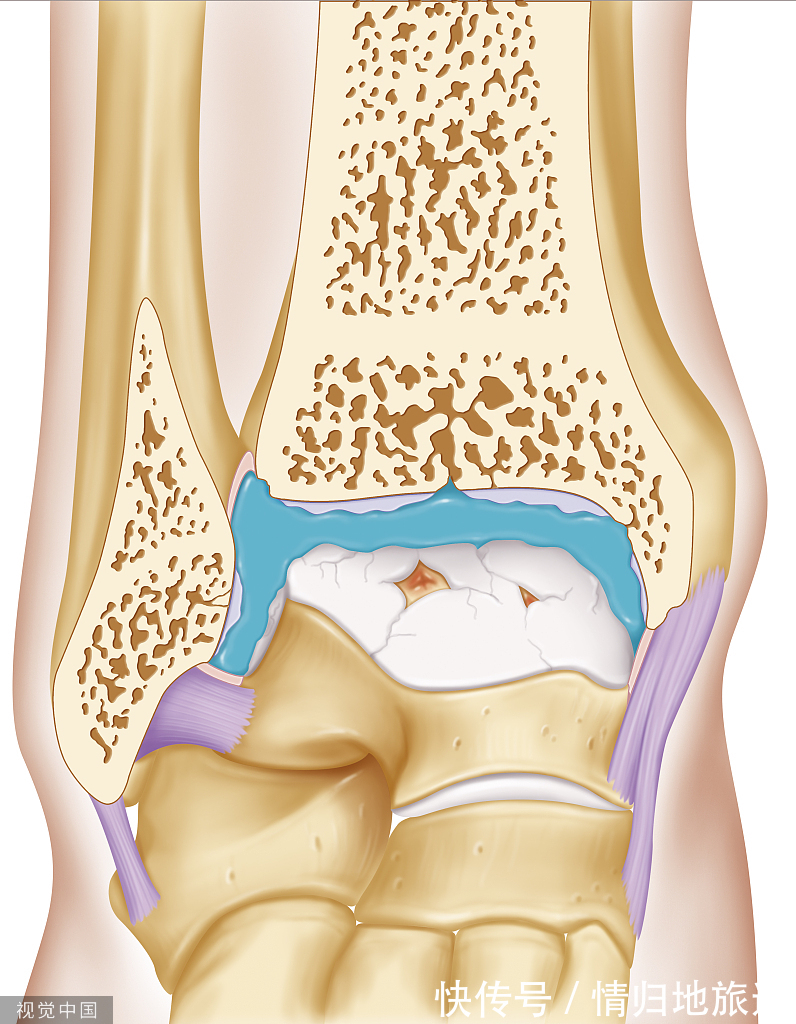 风湿病|成人斯蒂尔病，里的风湿病症状