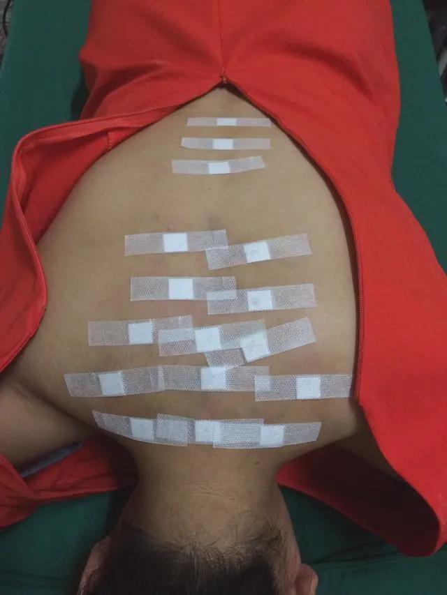 孩子|妈妈拼了!给孩子打生长激素、脊椎埋线花了18万,回头一看全是坑