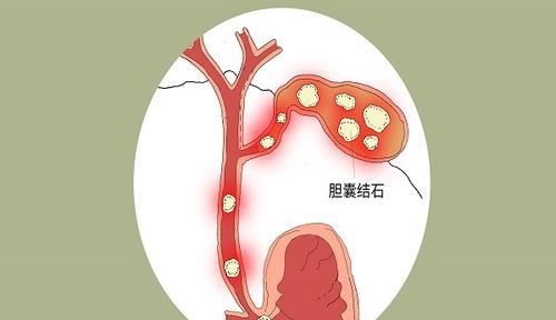  不切|胆囊有结石，在不切胆囊的前提下，用什么方法能排石？医生告诉你