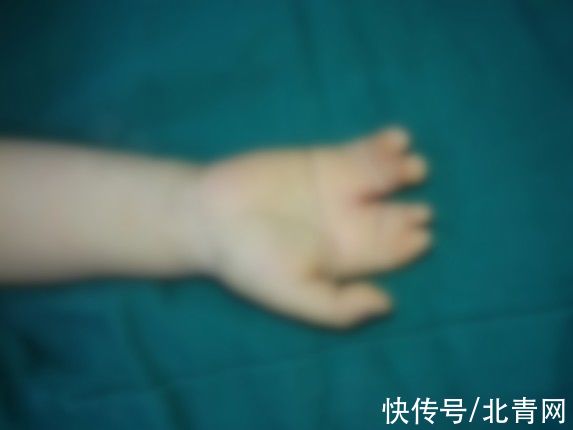 乐乐|双指粘连，12岁男孩手指比香蕉还粗！医生手术挽回手掌功能