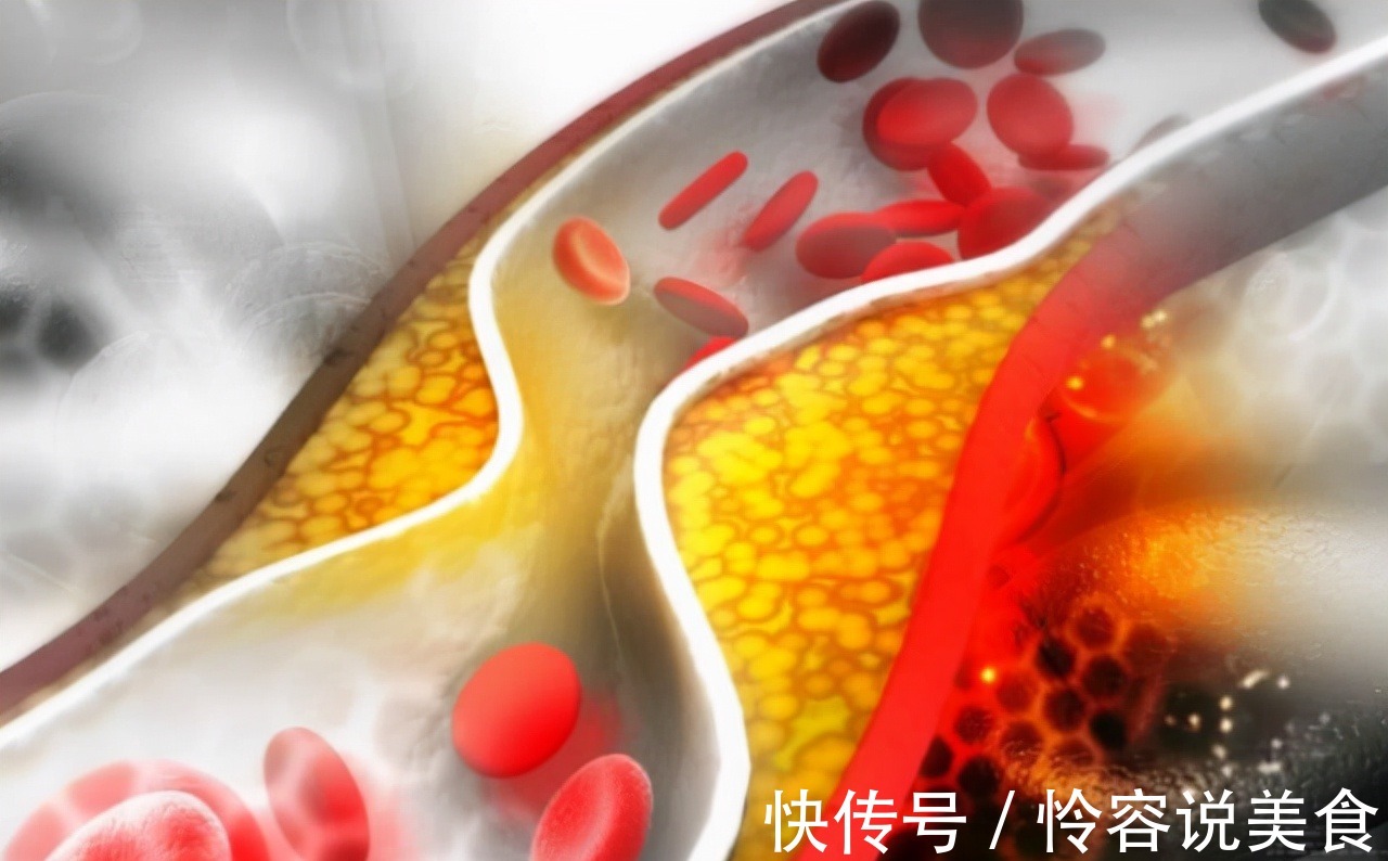 冠状动脉|多走路能降血脂医生提醒日常多吃这4物,或比走路效果好