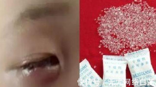 三氧化二铁干燥剂|孩子错把“它”当玩具,20分钟眼球就融化了,医生:无能为力