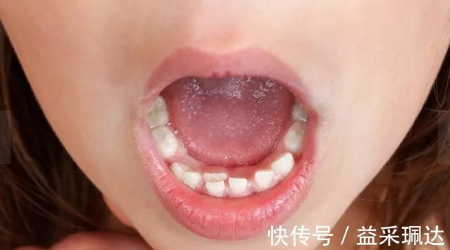不良习惯|吃的太“好”了医院每天接诊20多个双排牙孩子,家长别再这样喂了