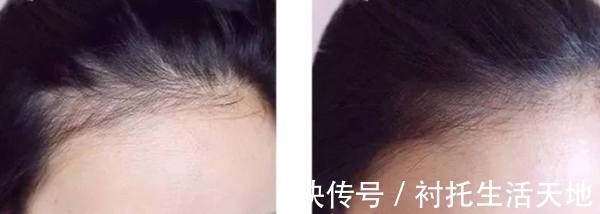 双氢睾酮|脱发自救指南，快快学起来