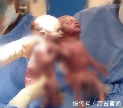 医生|做产检发现怀的是连体婴却仍要生,结果小孩出生那一刻所有人都!