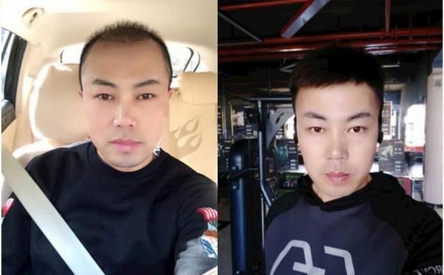 种植|天生发际线高还有救吗?试试发际线补发和自体头发种植,非常实用