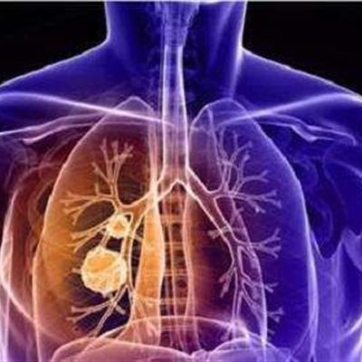 结节|体检发现肺结节，如何进一步检查以排除肺癌大夫建议您这么做！