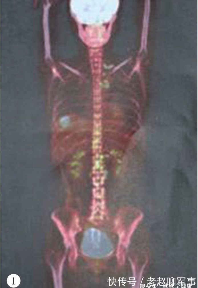 乐启生|48岁确诊乳腺癌晚期,从逃避到重生,8年时间她总结出抗癌秘诀