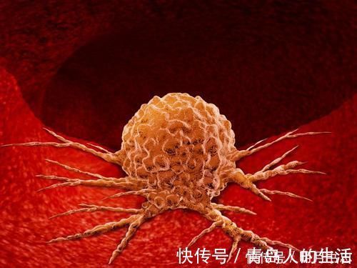 恶性肿瘤|良性肿瘤可以不用动手术?告诫:4类良性肿瘤“不好惹”