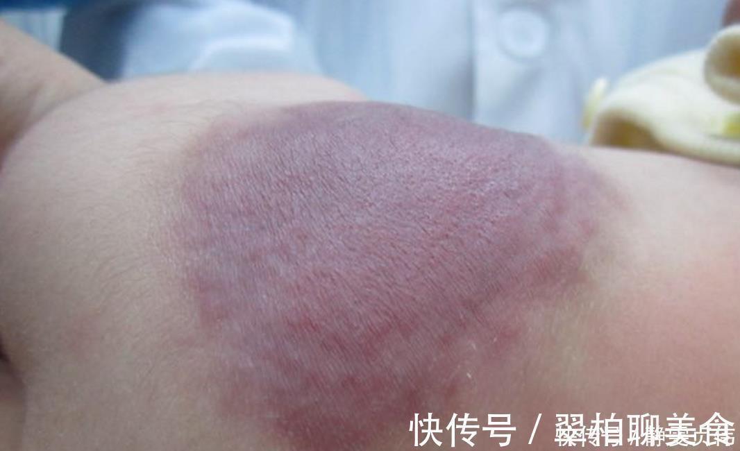 女孩|那个脸上有“蝙蝠”胎记的女孩,如今生活的怎么样?看完很欣慰