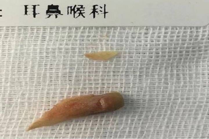 健康过春节|耳鼻咽喉头颈颅底外科:谨防食管异物及小儿气管异物