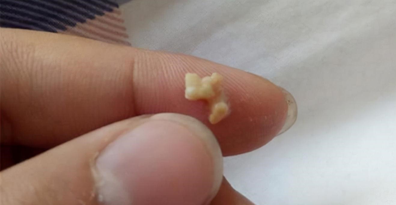 扁桃体结石|同学嫌弃儿子“嘴太臭”,妈妈带孩子检查,医生取出的颗粒是真臭