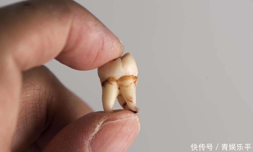 令人惊奇男子牙缝长出嫩芽,疼到不行专业医生分析…