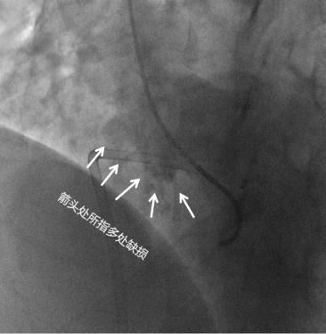间隔|心脏有5个洞！孕妇懵了：我怎么能安稳活这么多年？