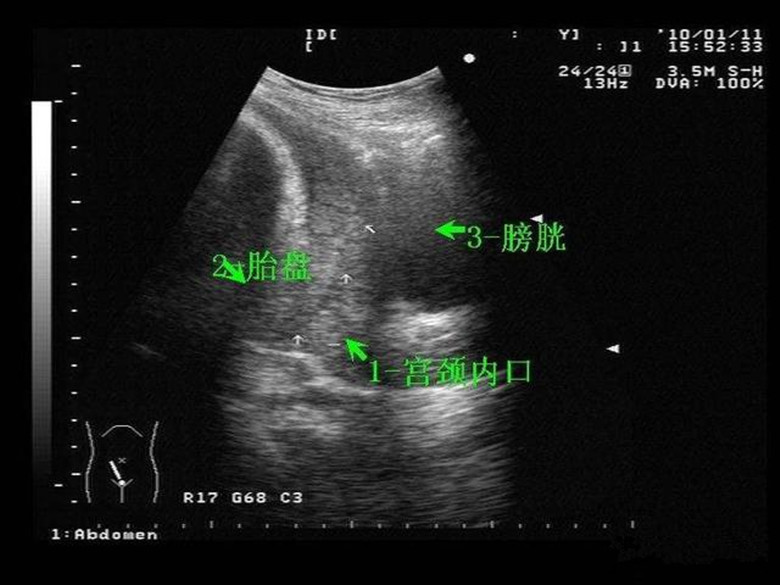 孕囊|怀孕最怕前置胎盘,5个方法来预防