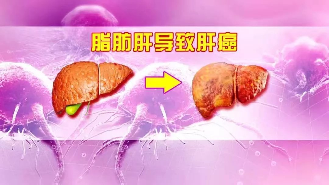 茶多酚|得了脂肪肝,全身都受累,4大癌症风险骤增,还伤血管!这份“逆转方法”请收好~