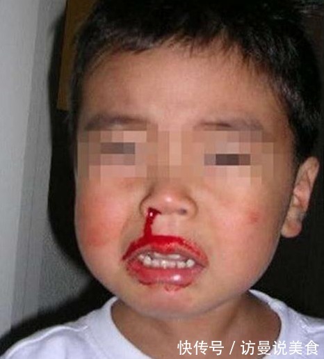 常识|5岁男孩流鼻血,送医被下病危通知书,医生叹气这种常识是错的