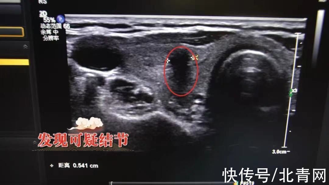 三脏同调法|查出结节、息肉，别掉以轻心，这几种情况易变成癌！中医调脏腑、化痰瘀、防癌变