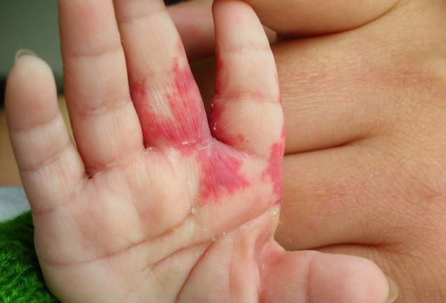 孕期|胎记到底是怎么来的医生孕期避开这3种行为,可减少胎记产生