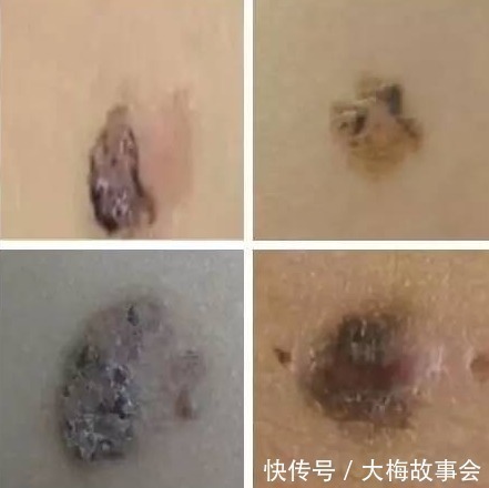 基底细胞癌|只因搓破身上一颗小痣,25岁男子患上癌,这些痣都需要谨慎