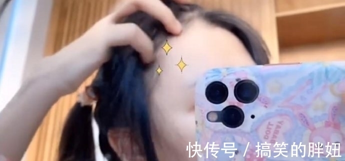 危机 蔡萝莉真的是一姐?出现秃头危机后,花10多万植发