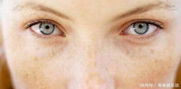 脸上长了黄褐斑,一直坚持3个方法,或许会让脸蛋光滑又干净