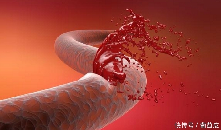 高血压,除了吃降压药,中医说:这4种植物煮水,降压也一样管用