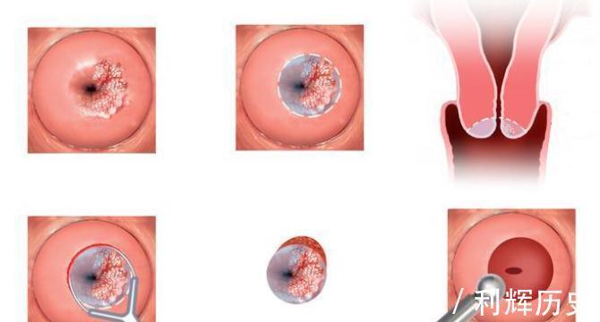 疼痛|注意,癌症早期有这些症状,早发现、早诊断、早治疗,提高治愈率