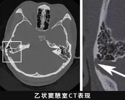 突发性|耳朵听到了心跳声——这可能是血管搏动性耳鸣