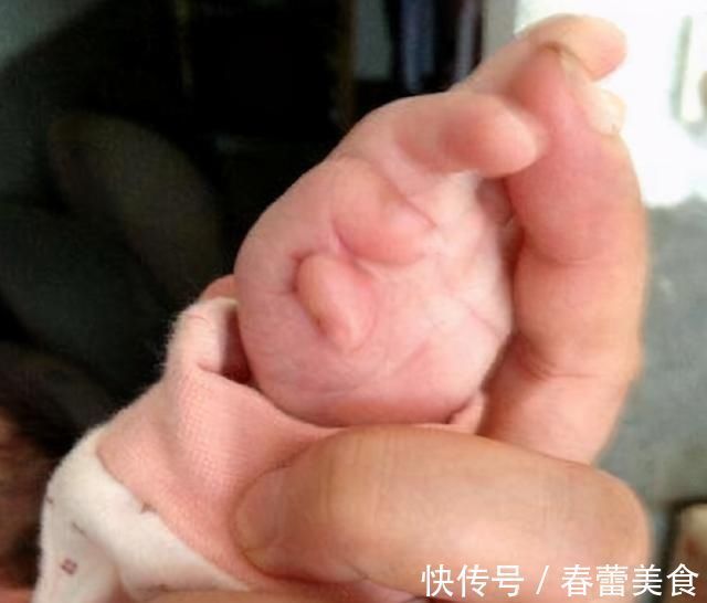 畸形儿|四维检查宝宝畸形,孕妈却执意生下孩子,出生后全家“沸腾了”