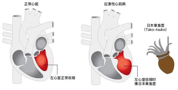 儿茶酚胺|太激动、太生气，老人竟因“心碎”进医院？