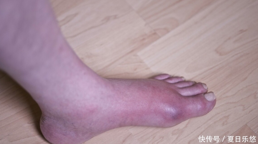 高嘌呤食物|4种食物是升高尿酸的“罪魁祸首”,若你也爱吃,尽早忌口!