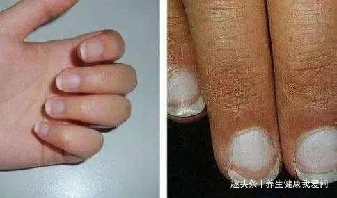 高血脂|寿命短的女人，手上会发出3种信号，若一个不占，说明你还算健康