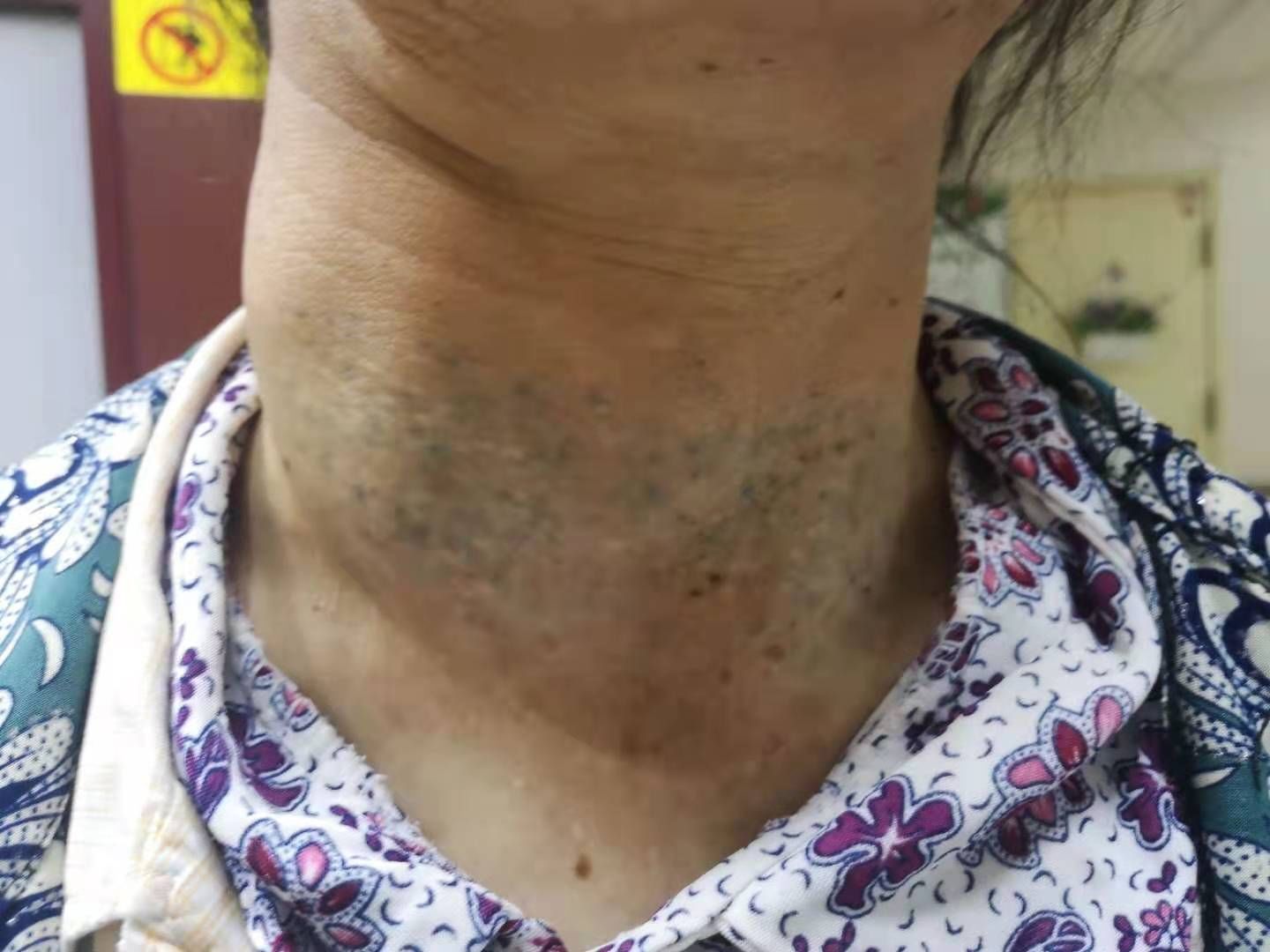 甲状腺癌|多学科协作 山大二院完成侵犯锁骨下静脉巨大甲状腺髓样癌切除术