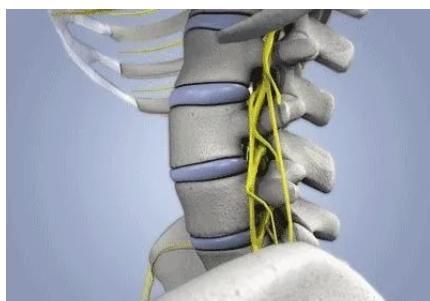 脖子|颈椎病竟能引发心绞痛！脖子造成的心脏病，你了解多少？