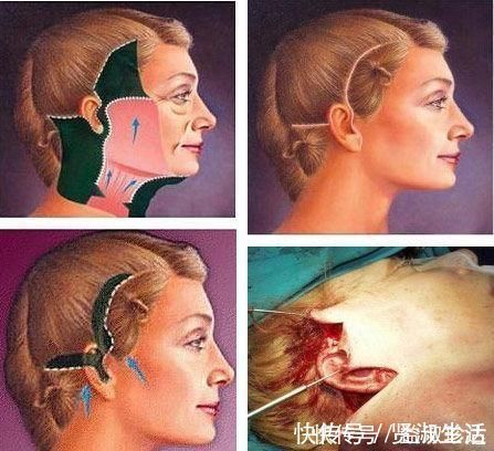 微创 聊一聊除了拉皮手术,微创小切口提升怎么样?多大年纪适合做?