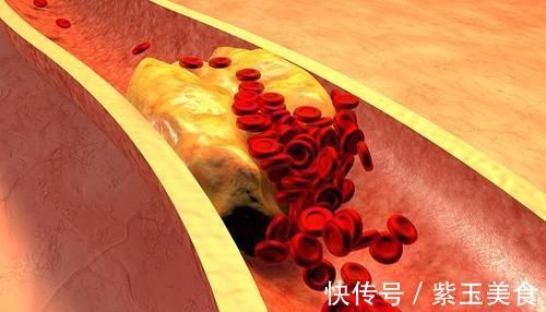 脂质|高血脂的“死对头”出现了,睡前喝一喝,甘油三酯稳定降到1.7