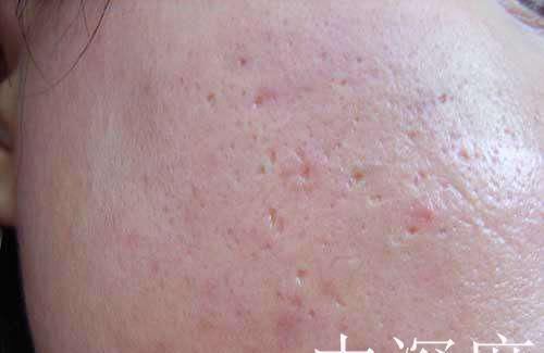 “痘坑”怎样修复,能否选择‘’无恢复期‘’的治疗项目