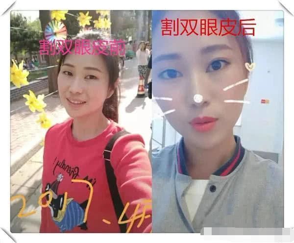 差距|割双眼皮前VS割双眼皮后，看见差距，眼睛变好看了但灵魂没了