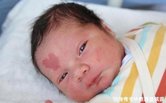 妈妈|胎记咋来的产科医生除了遗传,还与孕期的这3种行为有关