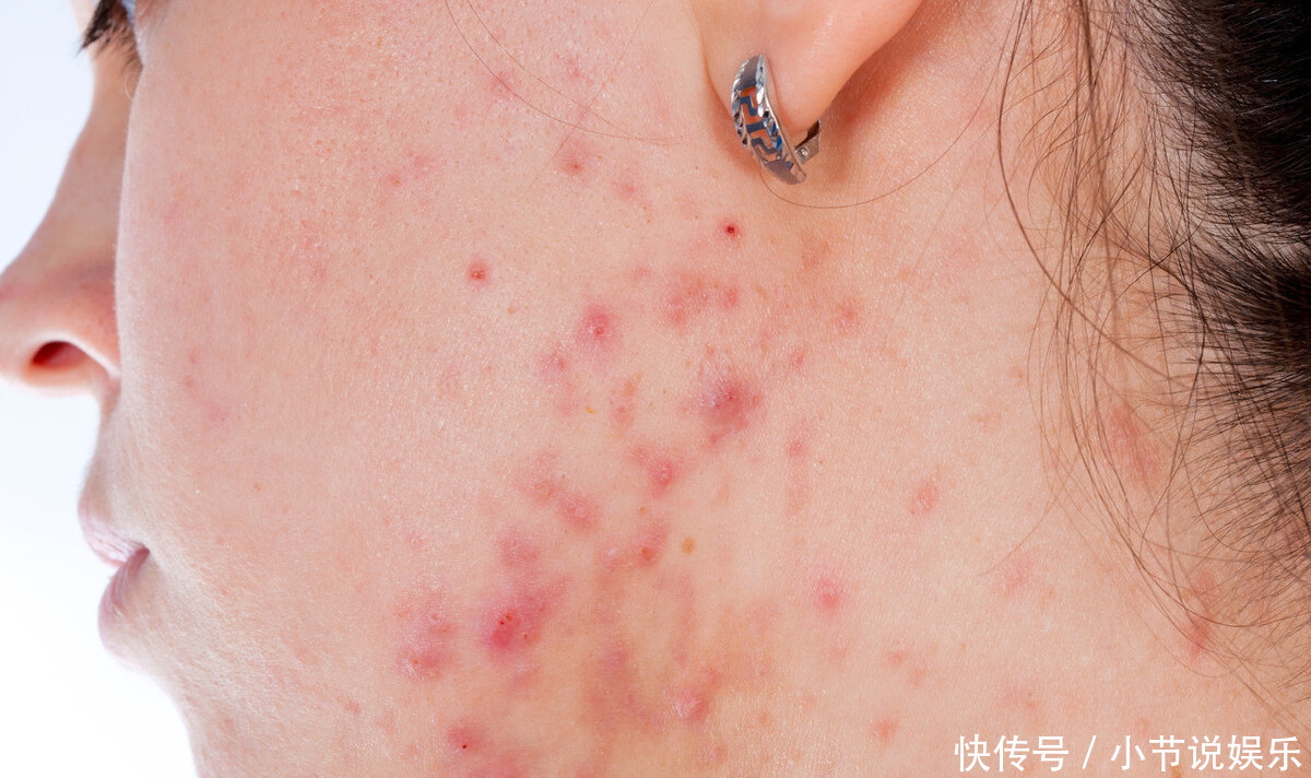 硫磺皂与普通肥皂有何不同可以长期使用硫磺皂洗脸吗一文说清