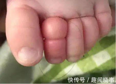 截肢|2个月宝宝险被截肢,每小时放一次血!凶手竟是妈妈一根头发