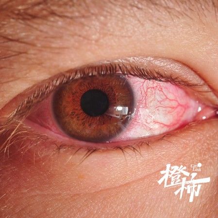 张煜|一阵风吹来，28岁女子“差点瞎了”！医生说她这个动作是大忌