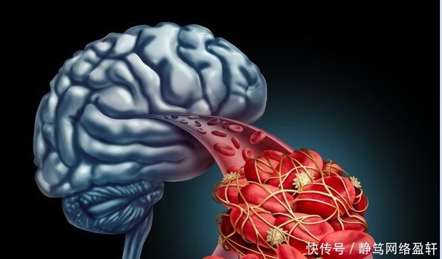发生|脑供血不足真凶找到了!常吃3物,多做2动作,早坚持血管早安全