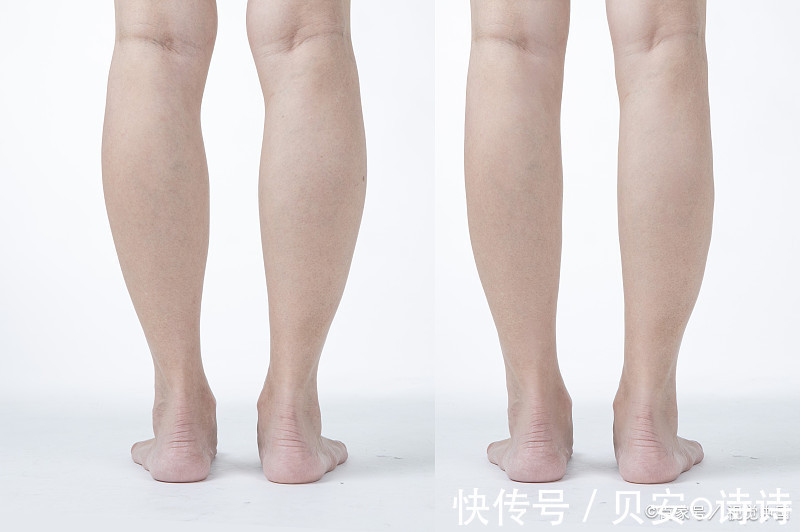 生理性水肿|贝安健康：孕期水肿和喝水太多的关系吗?