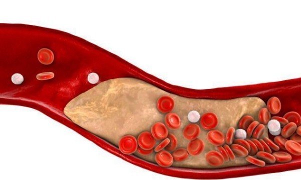 跑步|高血脂通过跑步能降下来吗要跑多久才可以本文讲出实情