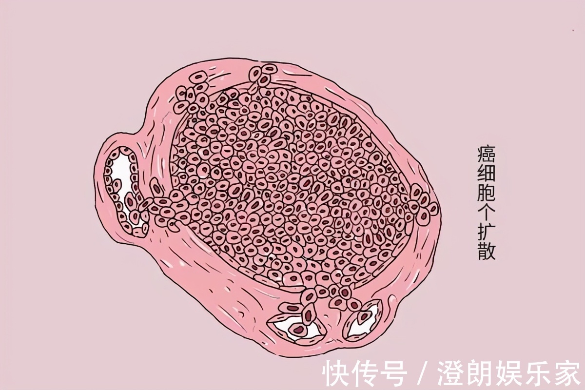 临床试验|70右的癌症患者，3年内都有一个共性，不是吸烟喝酒