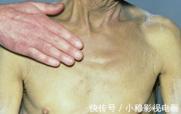 不良习惯|肝病发现即晚期？身体出现这3种异常后，或是肝病前兆，莫忽视